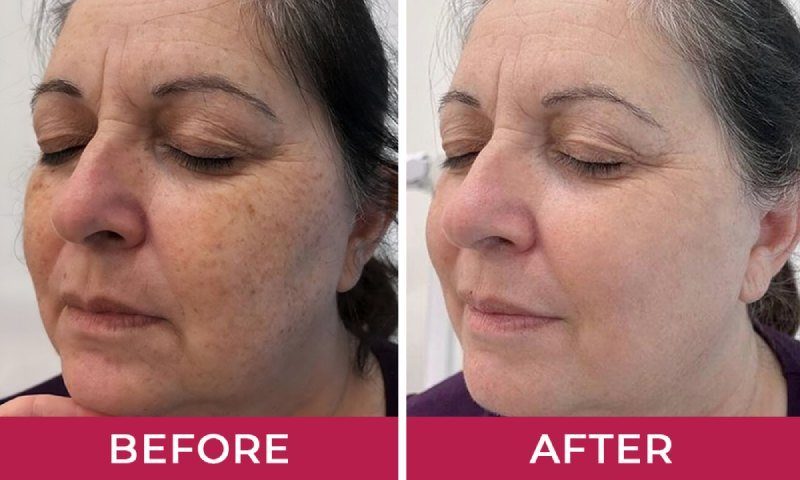 HydraLyft Face Mask Result